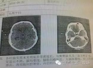 深圳男子被罕见&ldquo;吃脑虫&rdquo;侵入 十几天后病逝
